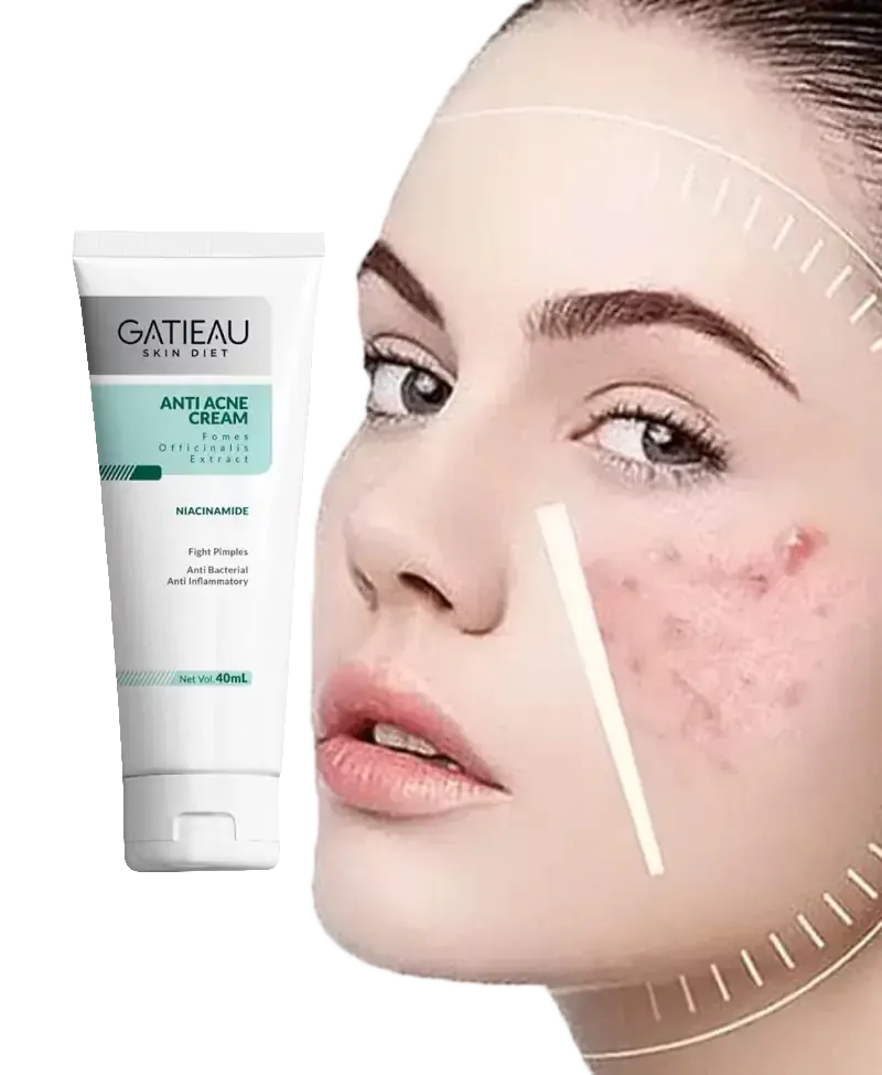 کرم ژل آنتی آکنه(ضد جوش و ضد لک)گاتیو بیوممتیک