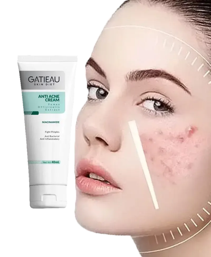 کرم ژل آنتی آکنه(ضد جوش و ضد لک)گاتیو بیوممتیک